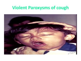 Violent Paroxysms of cough
 