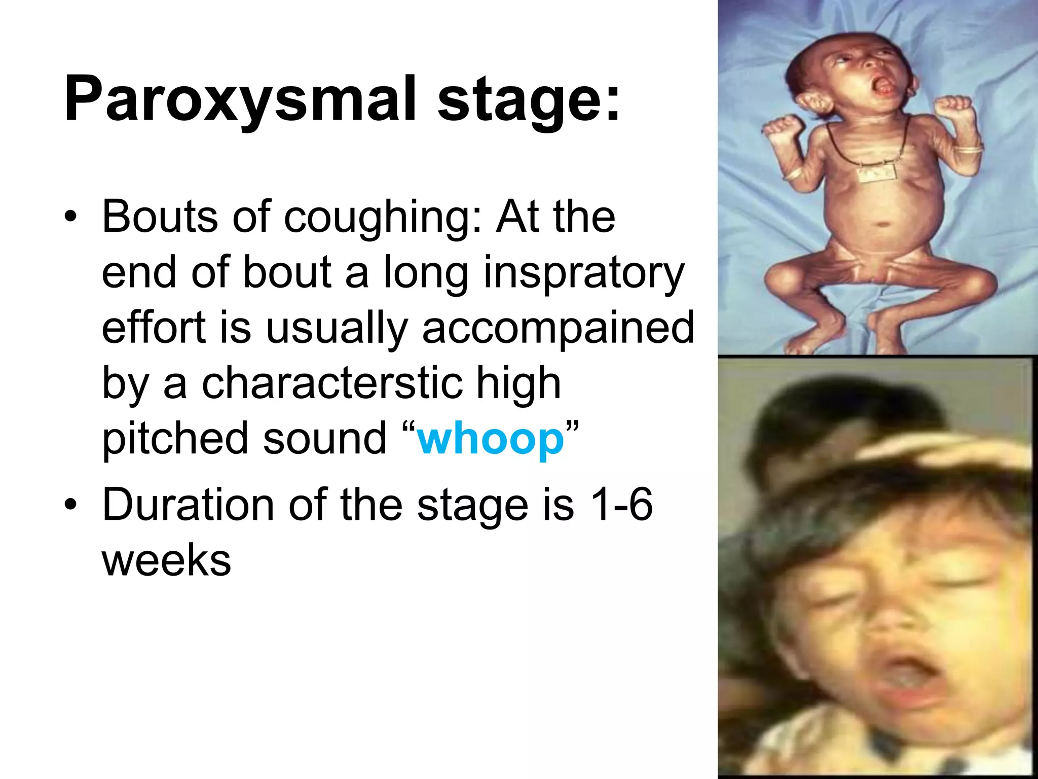 Paroxysmal stage:
• Bouts of coughing: At the
end of bout a long inspratory
effort is usually accompained
by a characterstic high
pitched sound “whoop”
• Duration of the stage is 1-6
weeks
 