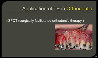 69
SFOT (surgically faciliatated orthodontic therapy )
 