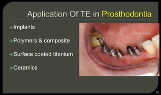Implants
Polymers & composite
Surface coated titanium
Ceramics
70
 