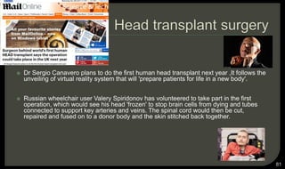  Dr Sergio Canavero plans to do the first human head transplant next year ,It follows the
unveiling of virtual reality system that will 'prepare patients for life in a new body'.
 Russian wheelchair user Valery Spiridonov has volunteered to take part in the first
operation, which would see his head 'frozen' to stop brain cells from dying and tubes
connected to support key arteries and veins. The spinal cord would then be cut,
repaired and fused on to a donor body and the skin stitched back together.
81
 