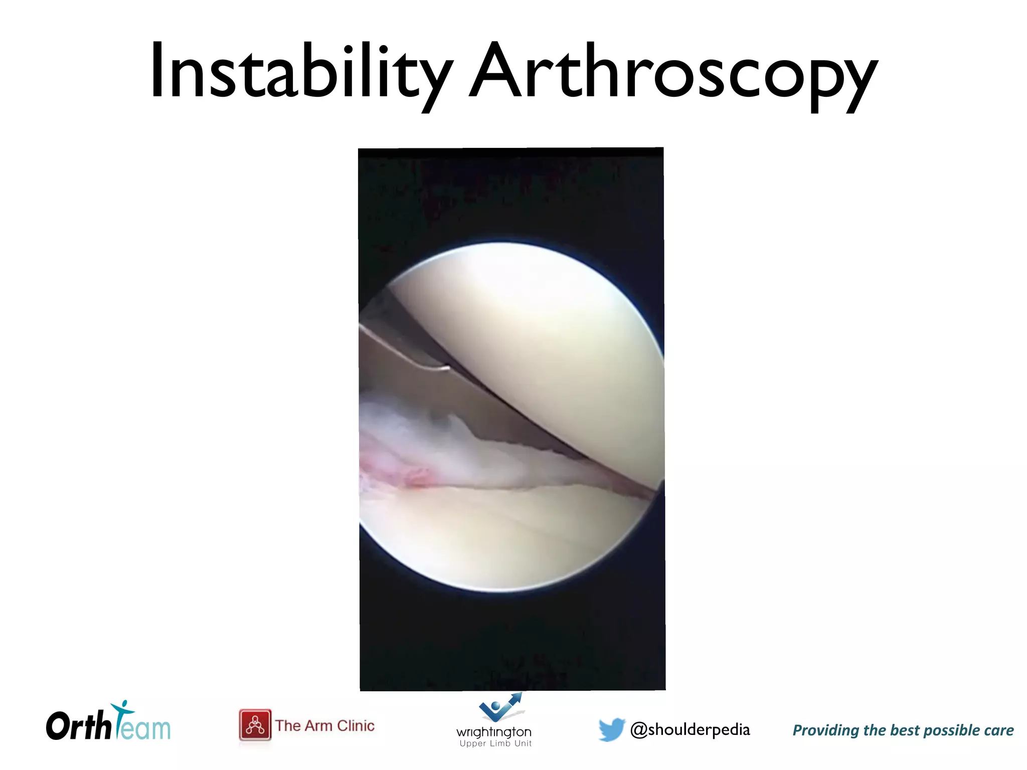 Providing)the)best)possible)care!@shoulderpedia
Instability Arthroscopy
 
