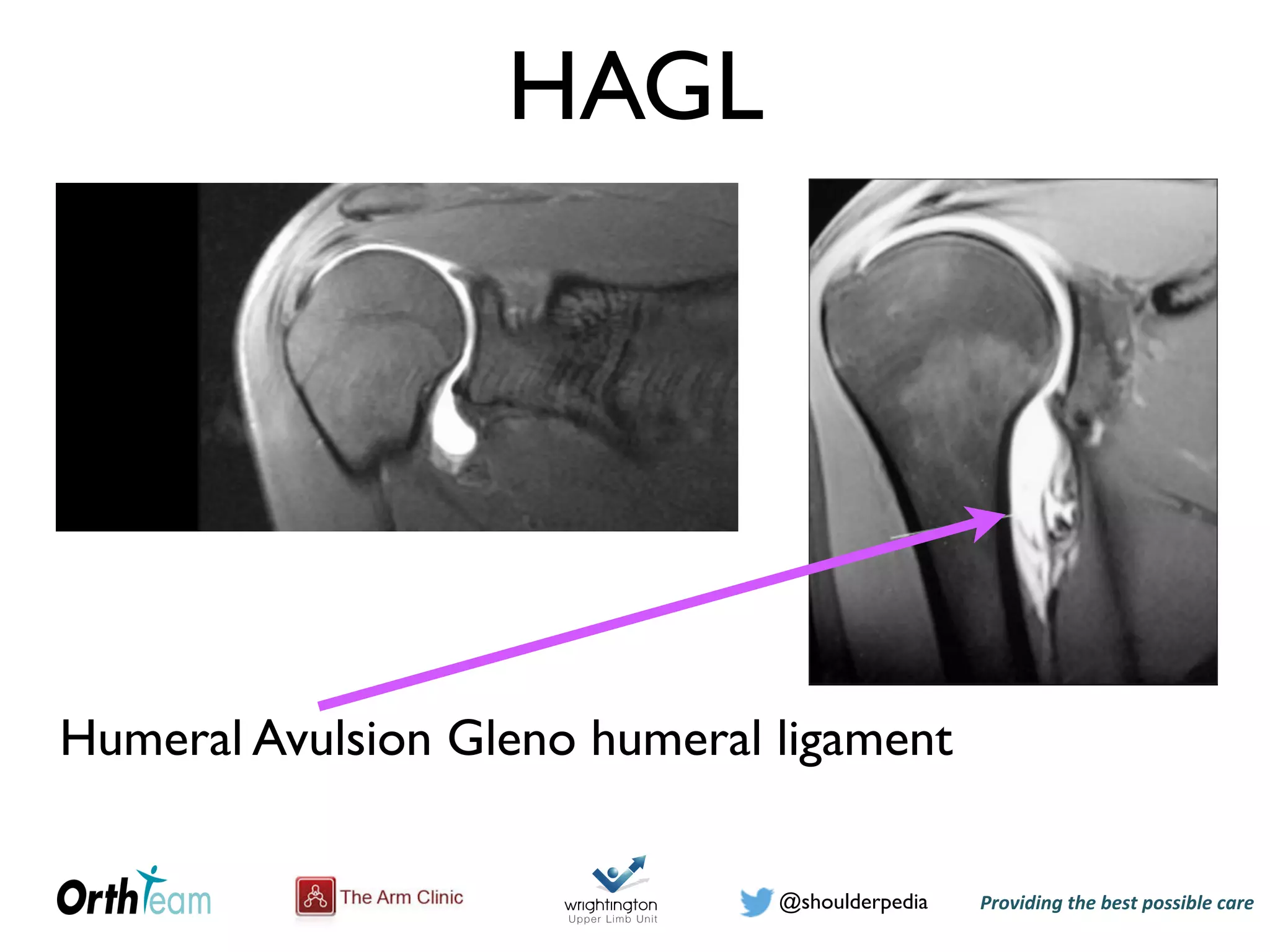 Providing)the)best)possible)care!@shoulderpedia
HAGL
Humeral Avulsion Gleno humeral ligament
 