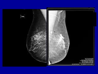 Evolving Trends in Breast MRI