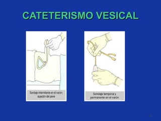 CATETERISMO VESICAL 