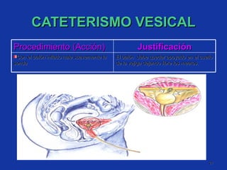 CATETERISMO VESICAL Procedimiento (Acción) Justificación Con el balón inflado hale suavemente la sonda  El balón  debe quedar apoyado en el cuello de la vejiga dejando libre los meatos. 