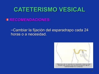 CATETERISMO VESICAL RECOMENDACIONES:  Cambiar la fijación del esparadrapo cada 24 horas o a necesidad. 