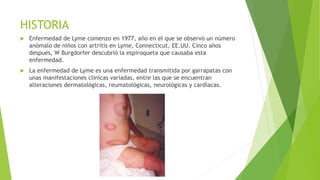 HISTORIA
 Enfermedad de Lyme comenzo en 1977, año en el que se observó un número
anómalo de niños con artritis en Lyme, Connecticut, EE.UU. Cinco años
después, W Burgdorfer descubrió la espiroqueta que causaba esta
enfermedad.
 La enfermedad de Lyme es una enfermedad transmitida por garrapatas con
unas manifestaciones clínicas variadas, entre las que se encuentran
alteraciones dermatológicas, reumatológicas, neurológicas y cardíacas.
 