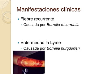 Manifestaciones clínicas
   Fiebre recurrente
    ◦ Causada por Borrelia recurrentis



   Enfermedad la Lyme
    ◦ Causada por Borrelia burgdorferi
 