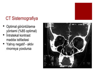CT Sisternografiya
? Optimal g?rntl m? ?
y?nt mi (%85 optimal)?
? ?ntratekal kontrast
madd istifad si? ?
? Yaln?? negatif - aktiv
rinorreya yoxdursa
 