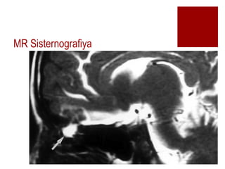 MR Sisternografiya
 