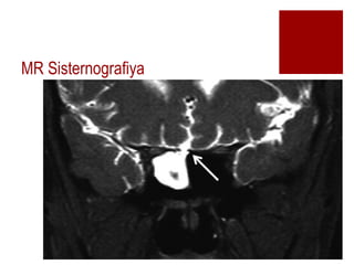 MR Sisternografiya
 