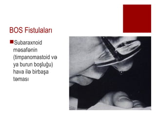 BOS Fistulalar?
?Subaraxnoid
m saf nin? ?
(timpanomastoid v?
ya burun bo?lu?u)
hava il birba?a?
t mas??
 