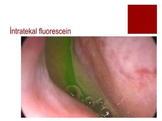 ?ntratekal fluorescein
 