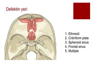 Defektin yeri
1. Ethmoid
2. Cribriform plate
3. Sphenoid sinus
4. Frontal sinus
5. Multiple
 
