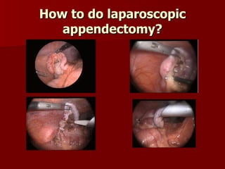 How to do laparoscopic appendectomy? 