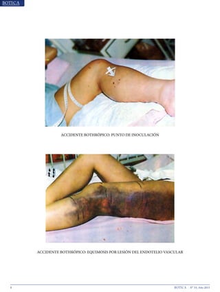 8 N° 33, Año 2015
ACCIDENTE BOTHRÓPICO: PUNTO DE INOCULACIÓN
ACCIDENTE BOTHRÓPICO: EQUIMOSIS POR LESIÓN DEL ENDOTELIO VASCULAR
 