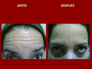 ANTES                                          DESPUES
