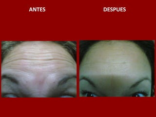 ANTES                                          DESPUES
