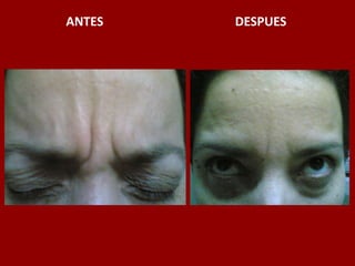 ANTES                                          DESPUES