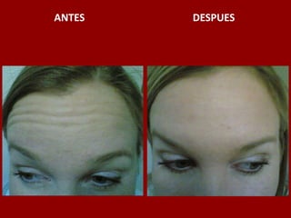 ANTES                                          DESPUES