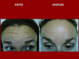 ANTES                                          DESPUES