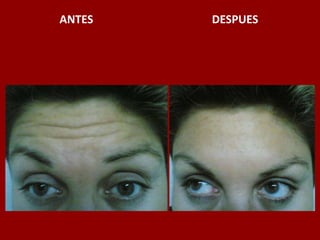 ANTES                                          DESPUES