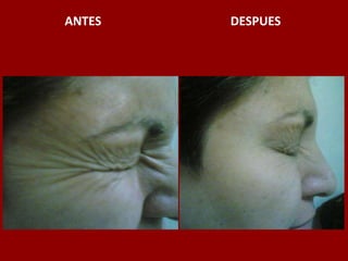 ANTES                                          DESPUES