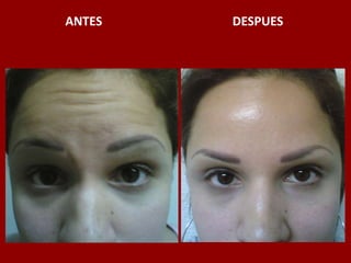 ANTES                                          DESPUES