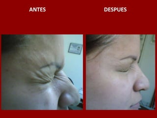 ANTES                                          DESPUES