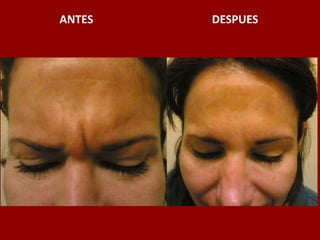 ANTES                                          DESPUES