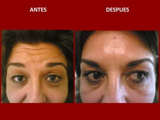ANTES                                          DESPUES