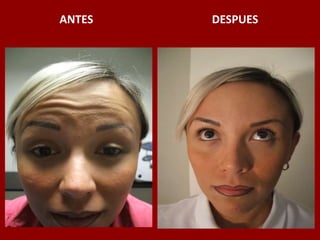 ANTES                                          DESPUES