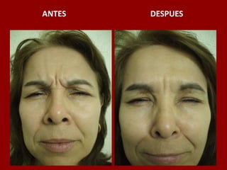 ANTES                                          DESPUES