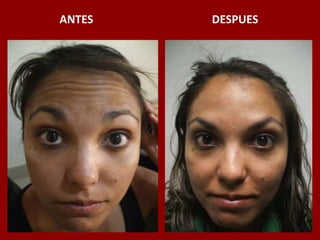ANTES                                          DESPUES