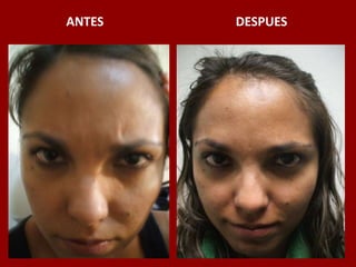 ANTES                                          DESPUES