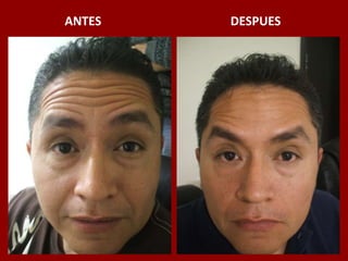 ANTES                                          DESPUES