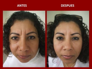 ANTES                                          DESPUES
