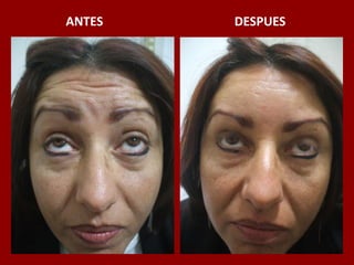 ANTES                                          DESPUES