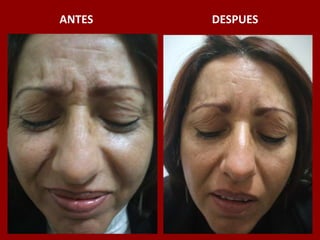 ANTES                                          DESPUES