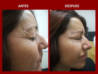 ANTES                                          DESPUES