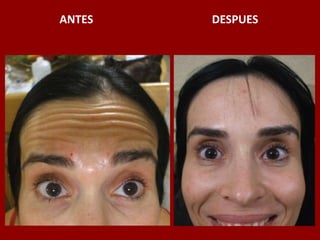 ANTES                                          DESPUES