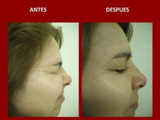ANTES                                          DESPUES