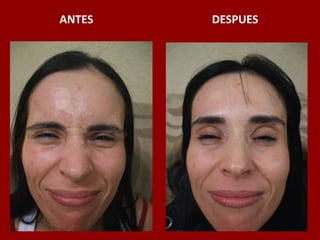 ANTES                                          DESPUES