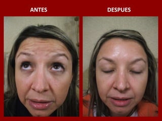 ANTES                                          DESPUES