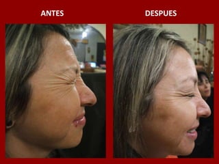 ANTES                                          DESPUES