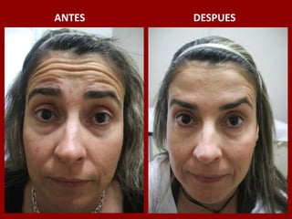 ANTES                                          DESPUES