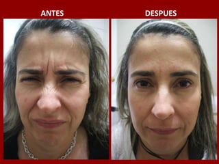 ANTES                                          DESPUES