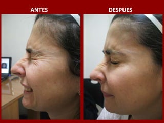 ANTES                                          DESPUES