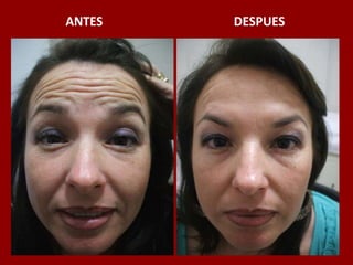 ANTES                                          DESPUES